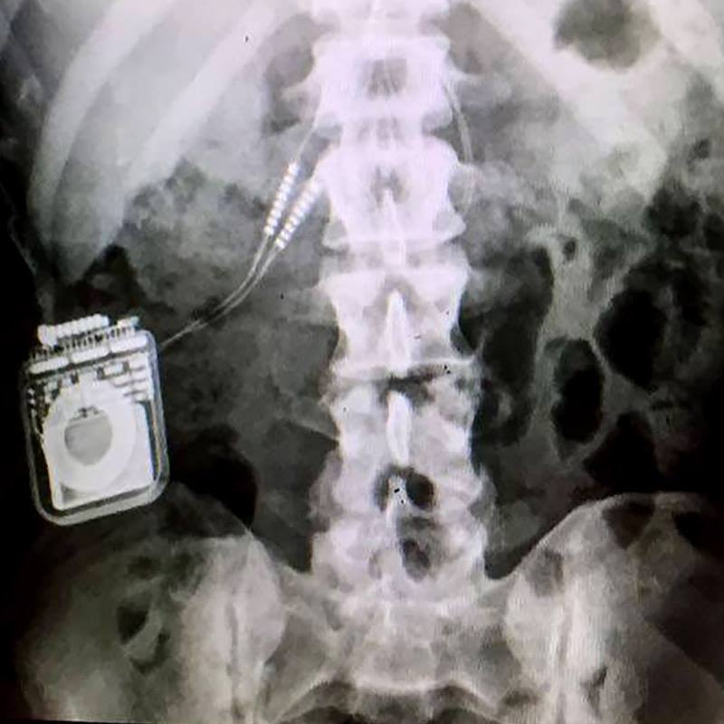 ESTIMULAÇAO IPIDURAL (3)