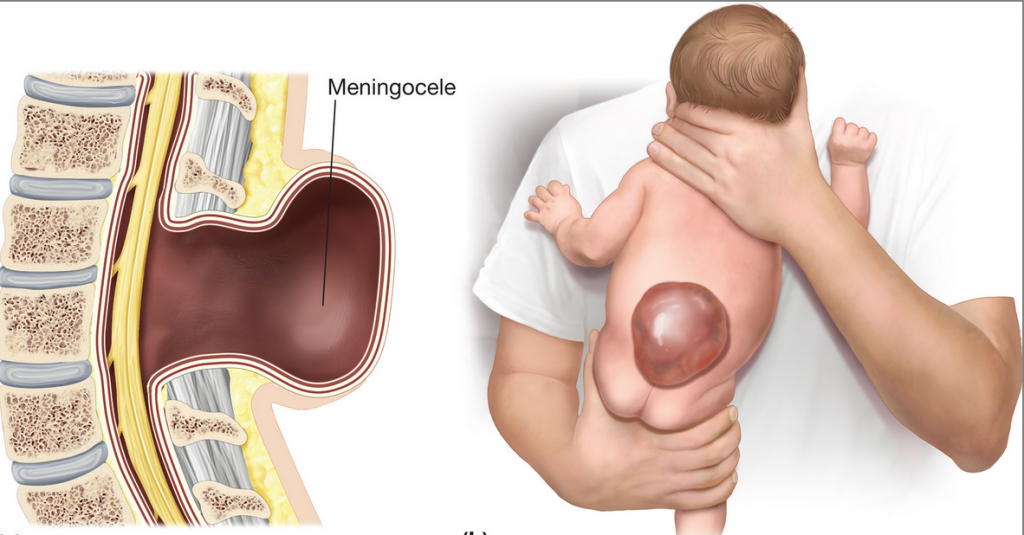 meningocele-crianca-com-deficiencia-casadaptada